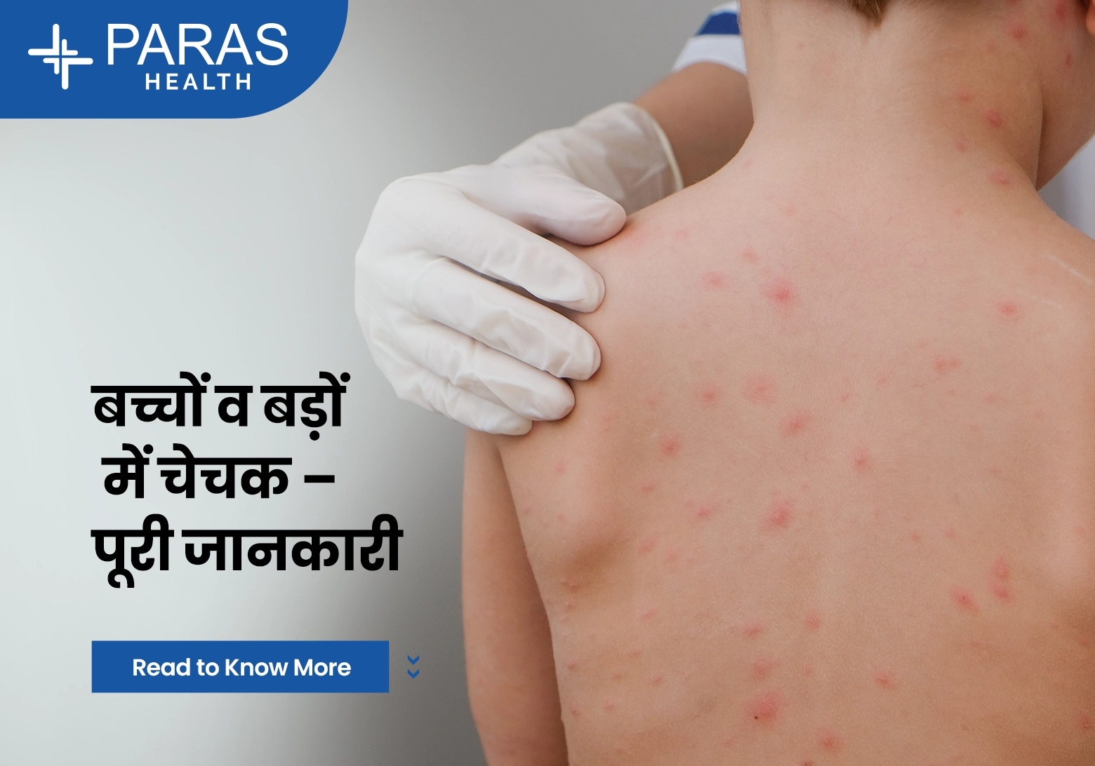 बच्चों और बड़ों में चेचक (Chickenpox): कारण, लक्षण, इलाज और बचाव
